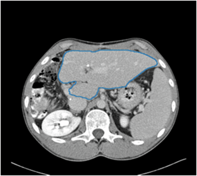AI generated CT findings - AI-Generated Annotations Dataset for Diverse Cancer Radiology ...