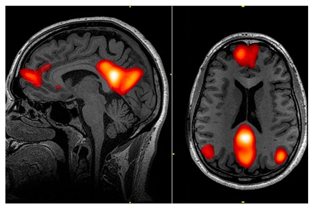 Artificial intelligence brain scan - Brain scan and artificial intelligence could help predict whether ...